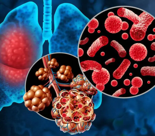Pneumococcal Disease Clinical Trial