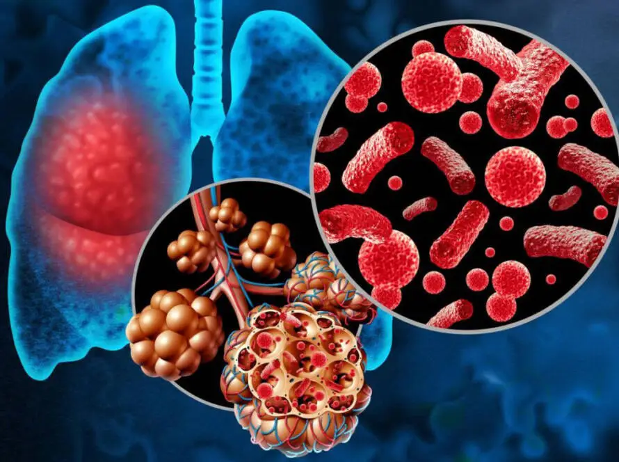 Pneumococcal Disease Clinical Trial