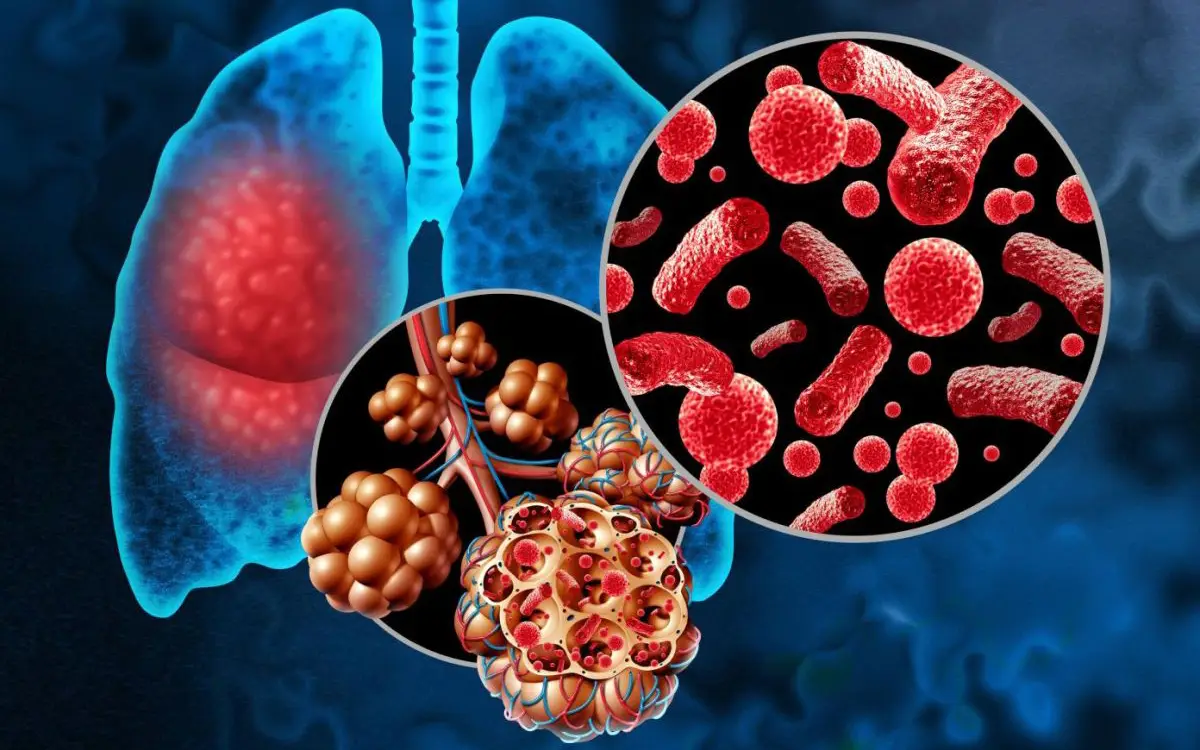 Pneumococcal Disease