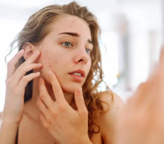 Acne Clinical Trial