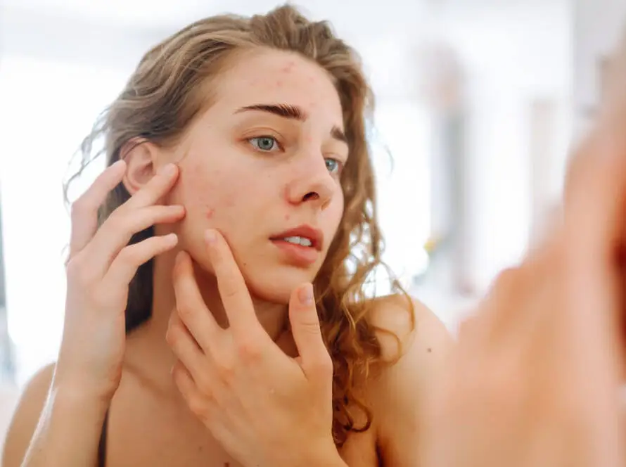 Acne Clinical Trial