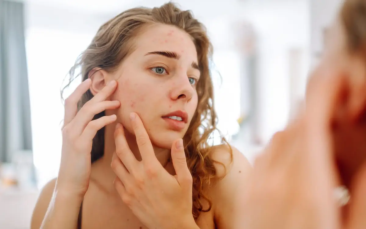 Acne Clinical Trials